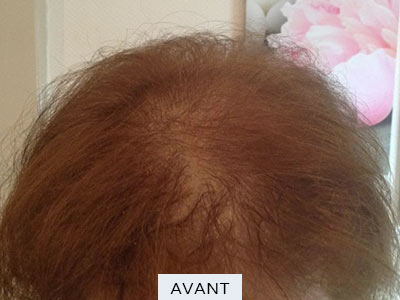 repigmentation-cheveux